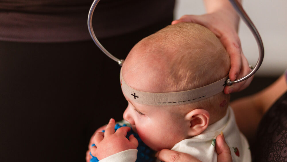 Plagiocéphalie du bébé : mesure au craniomètre